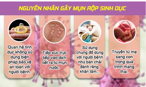 Nguyên Nhân Gây Mụn Rộp Sinh Dục Nữ