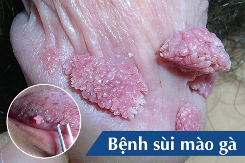 Phương pháp hỗ trợ điều trị sùi mào gà