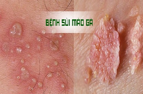 Nguyên nhân nào gây bệnh sùi mào gà?