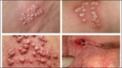 Phương pháp trị liệu mụn rộp sinh dục