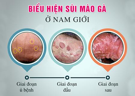 dau-hieu-sui-mao-ga-nam.jpg