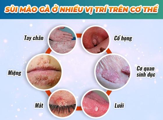 sui-mao-ga-o-nhieu-vi-tri-tren-co-the.jpg