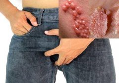 Hỗ trợ điều trị mụn sinh dục nam giới