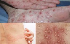 Phương pháp trị liệu bệnh giang mai