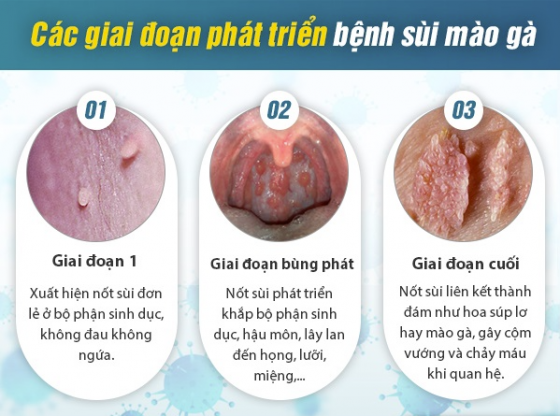Tổng quan bệnh sùi mào gà ở nam và nữ