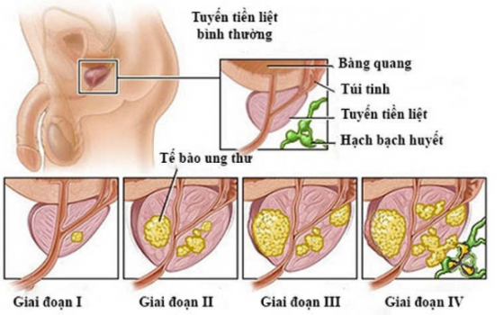 Tiểu buốt tiểu dắt, tiểu mủ nguy cơ bệnh lậu