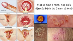 Hình ảnh bệnh lậu ở nam và nữ