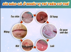 Cách Chữa Sùi Mào Gà